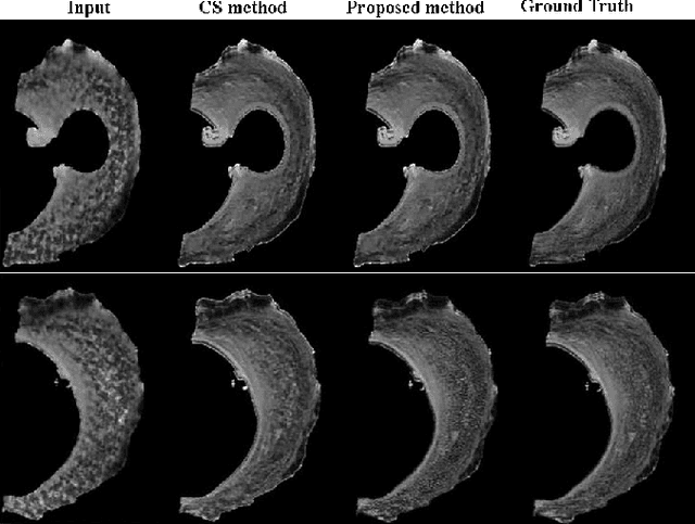 Figure 3 for Self-Learned Kernel Low Rank Approach TO Accelerated High Resolution 3D Diffusion MRI
