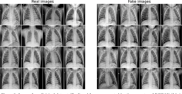 Figure 3 for Evaluation of Deep Convolutional Generative Adversarial Networks for data augmentation of chest X-ray images