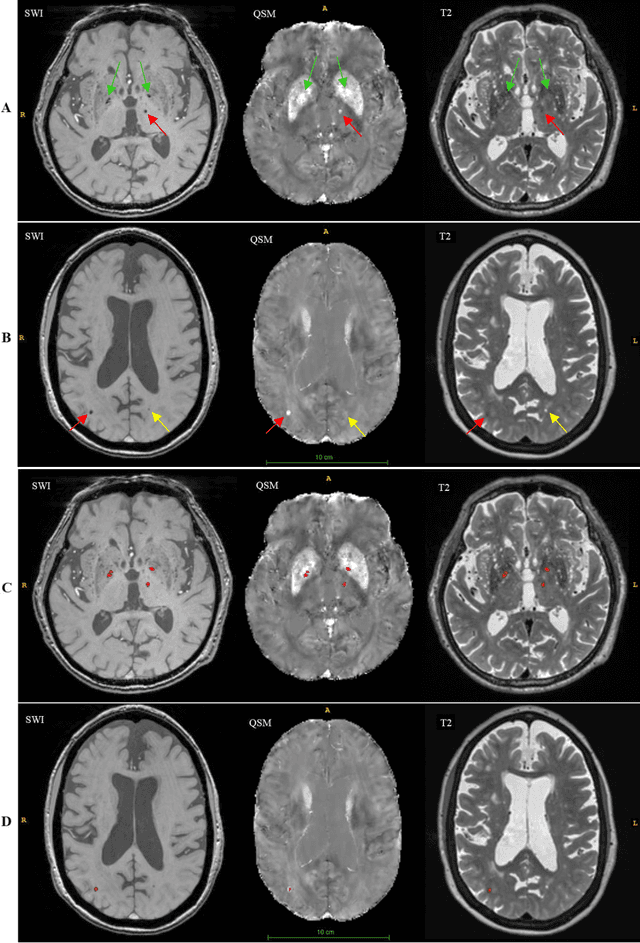 Figure 2 for DEEPMIR: A DEEP convolutional neural network for differential detection of cerebral Microbleeds and IRon deposits in MRI