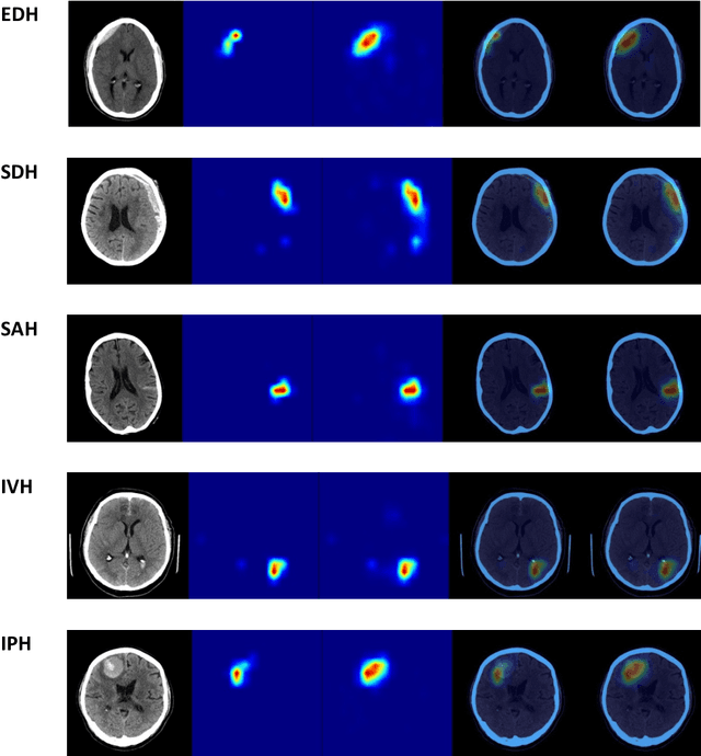 Figure 3 for A Real-World Demonstration of Machine Learning Generalizability: Intracranial Hemorrhage Detection on Head CT