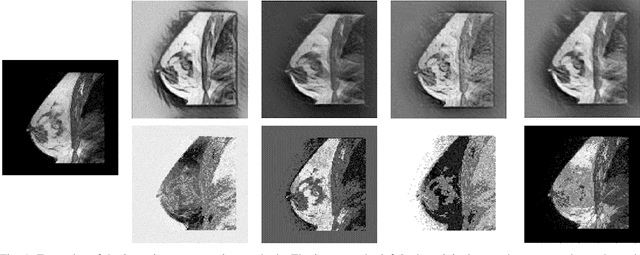 Figure 1 for Intensity augmentation for domain transfer of whole breast segmentation in MRI