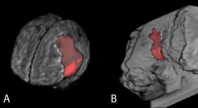 Figure 1 for Impact of Spherical Coordinates Transformation Pre-processing in Deep Convolution Neural Networks for Brain Tumor Segmentation and Survival Prediction