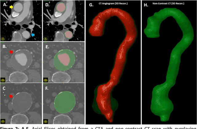 Figure 3 for A Deep Learning Approach to Automate High-Resolution Blood Vessel Reconstruction on Computerized Tomography Images With or Without the Use of Contrast Agent