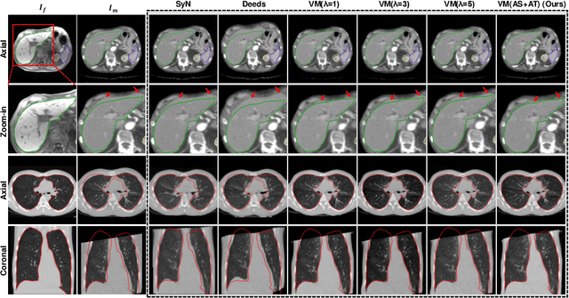 Figure 3 for Double-Uncertainty Assisted Spatial and Temporal Regularization Weighting for Learning-based Registration