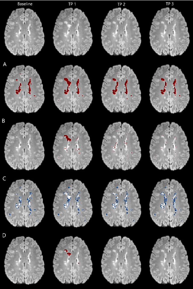 Figure 3 for Automatic detection of lesion load change in Multiple Sclerosis using convolutional neural networks with segmentation confidence