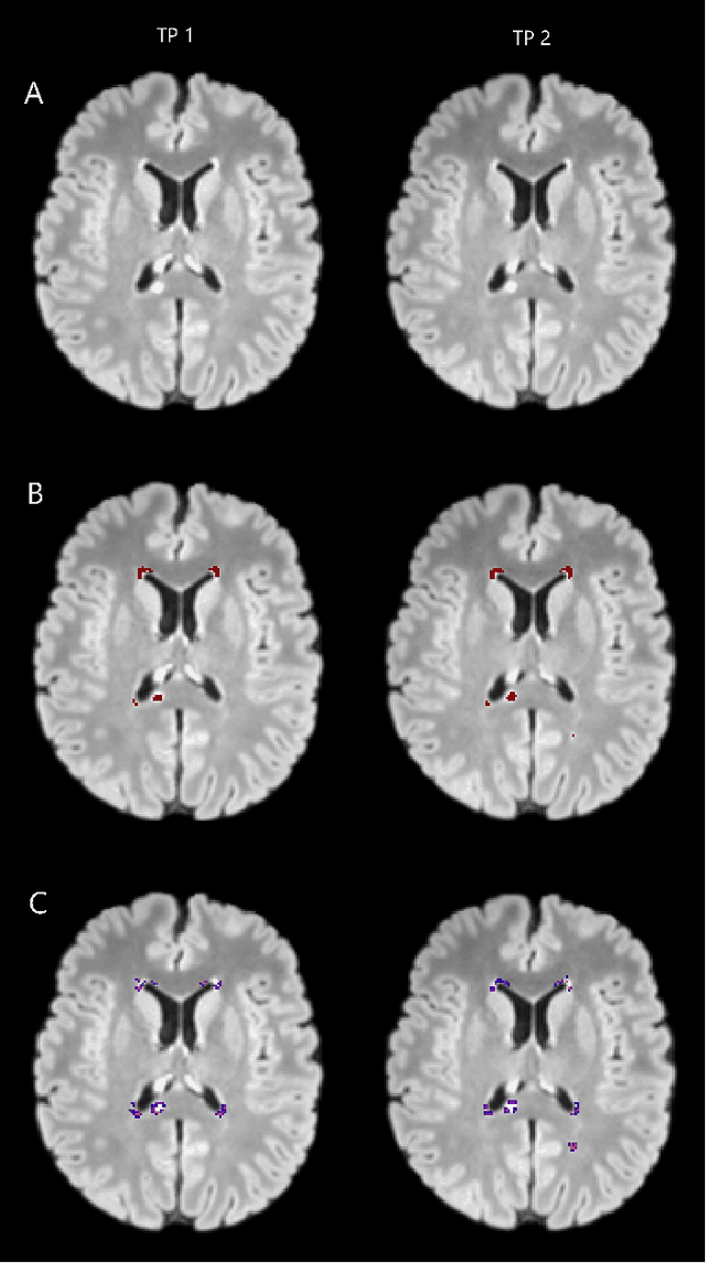 Figure 4 for Automatic detection of lesion load change in Multiple Sclerosis using convolutional neural networks with segmentation confidence