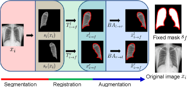 Figure 1 for Improved Generative Model for Weakly Supervised Chest Anomaly Localization via Pseudo-paired Registration with Bilaterally Symmetrical Data Augmentation