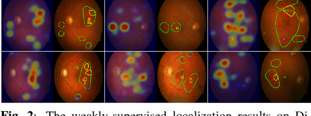 Figure 3 for Weakly-supervised localization of diabetic retinopathy lesions in retinal fundus images