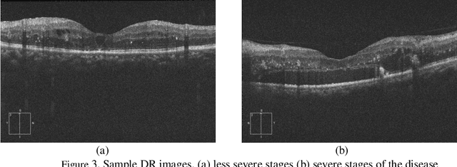 Figure 3 for OCTID: Optical Coherence Tomography Image Database