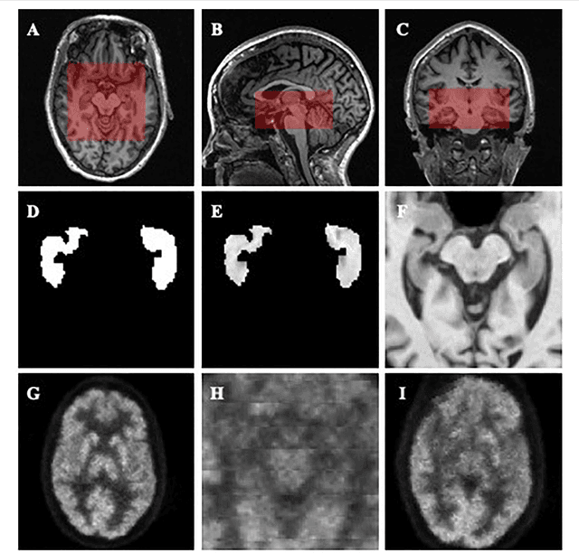 Figure 2 for Diagnosis of Alzheimer's Disease via Multi-modality 3D Convolutional Neural Network