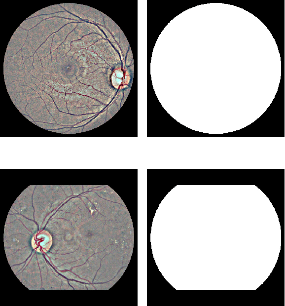 Figure 1 for An Interpretable Multiple-Instance Approach for the Detection of referable Diabetic Retinopathy from Fundus Images