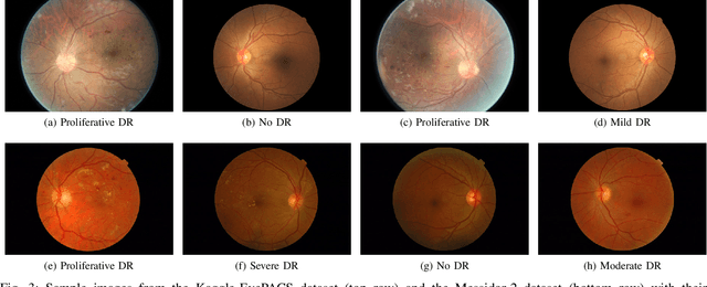 Figure 2 for An Interpretable Multiple-Instance Approach for the Detection of referable Diabetic Retinopathy from Fundus Images