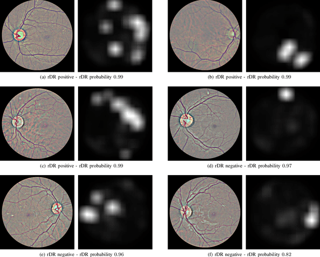 Figure 4 for An Interpretable Multiple-Instance Approach for the Detection of referable Diabetic Retinopathy from Fundus Images