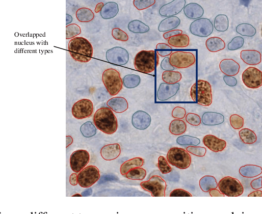 Figure 1 for A deep learning pipeline for breast cancer ki-67 proliferation index scoring