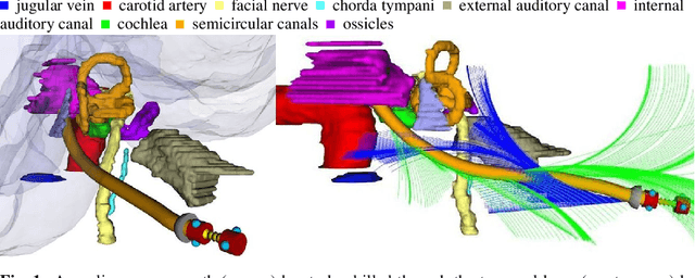 Figure 1 for Planning Nonlinear Access Paths for Temporal Bone Surgery
