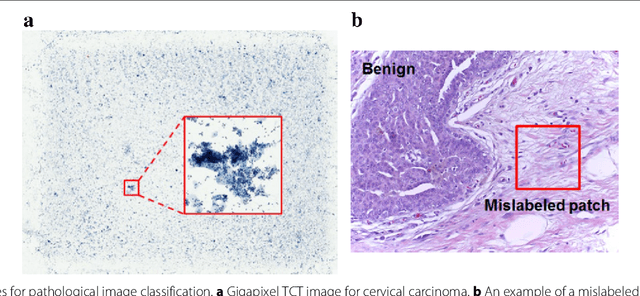 Figure 1 for Reversed Active Learning based Atrous DenseNet for Pathological Image Classification
