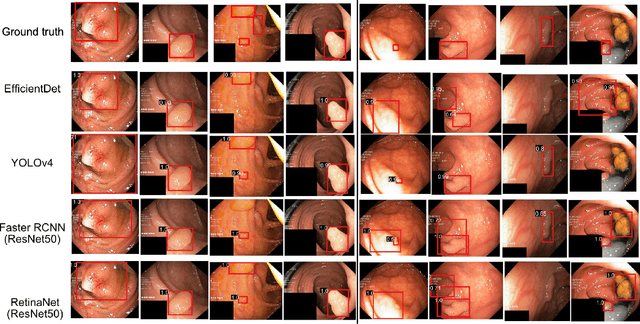 Figure 3 for Real-Time Polyp Detection, Localisation and Segmentation in Colonoscopy Using Deep Learning