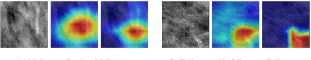 Figure 1 for Effect of Random Histogram Equalization on Breast Calcification Analysis Using Deep Learning