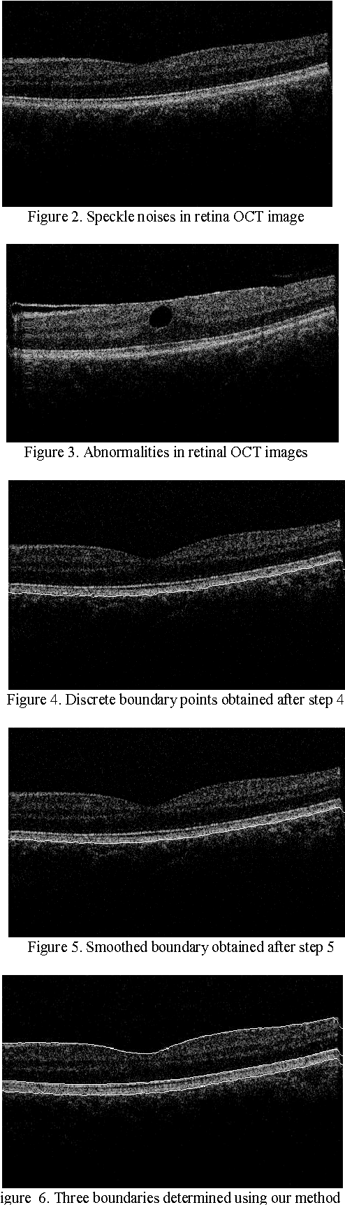 Figure 2 for A 3D Segmentation Method for Retinal Optical Coherence Tomography Volume Data
