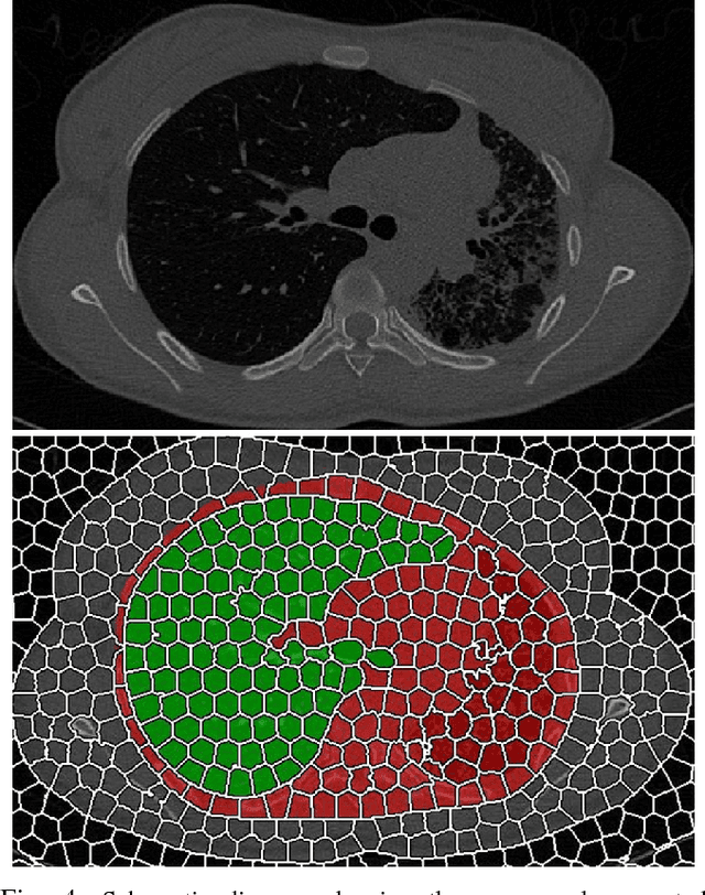 Figure 4 for Near-optimal Keypoint Sampling for Fast Pathological Lung Segmentation