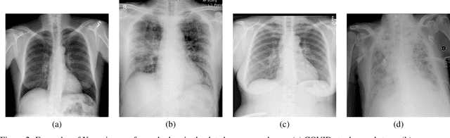 Figure 4 for Early Screening of SARS-CoV-2 by Intelligent Analysis of X-Ray Images