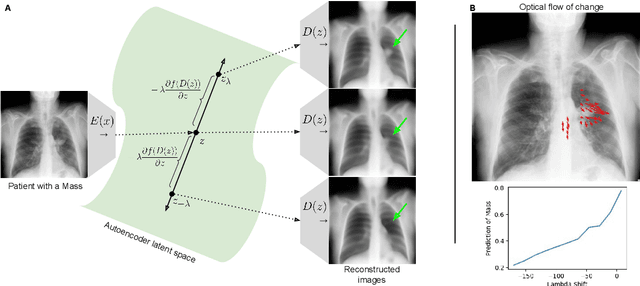 Figure 1 for Gifsplanation via Latent Shift: A Simple Autoencoder Approach to Progressive Exaggeration on Chest X-rays