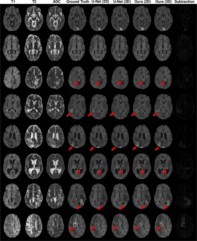 Figure 4 for Synthesizing MR Image Contrast Enhancement Using 3D High-resolution ConvNets