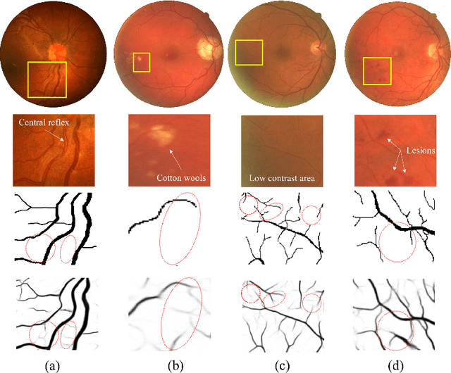 Figure 3 for Patch-based Generative Adversarial Network Towards Retinal Vessel Segmentation