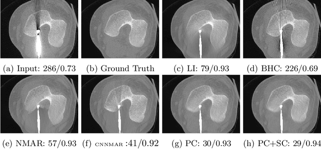 Figure 4 for Generative Mask Pyramid Network for CT/CBCT Metal Artifact Reduction with Joint Projection-Sinogram Correction