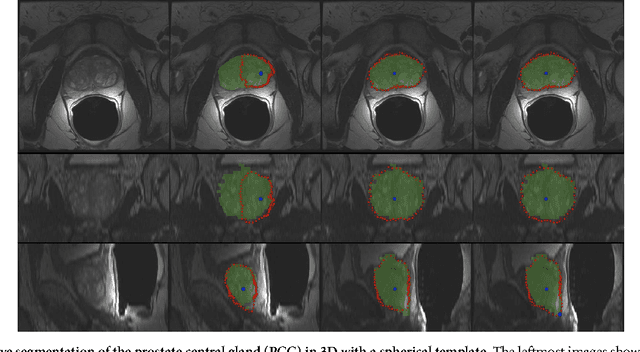 Figure 4 for Refinement-Cut: User-Guided Segmentation Algorithm for Translational Science