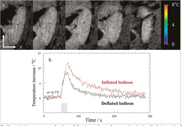 Figure 1 for MRI-Guided High Intensity Focused Ultrasound of Liver and Kidney