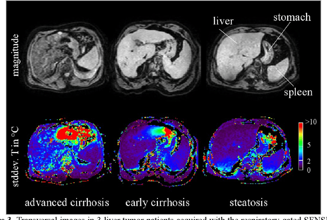 Figure 2 for MRI-Guided High Intensity Focused Ultrasound of Liver and Kidney