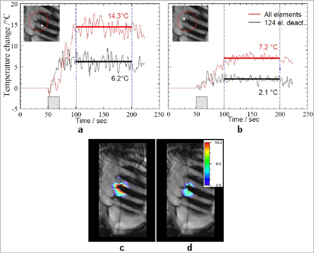 Figure 3 for MRI-Guided High Intensity Focused Ultrasound of Liver and Kidney
