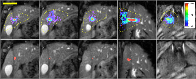 Figure 4 for MRI-Guided High Intensity Focused Ultrasound of Liver and Kidney