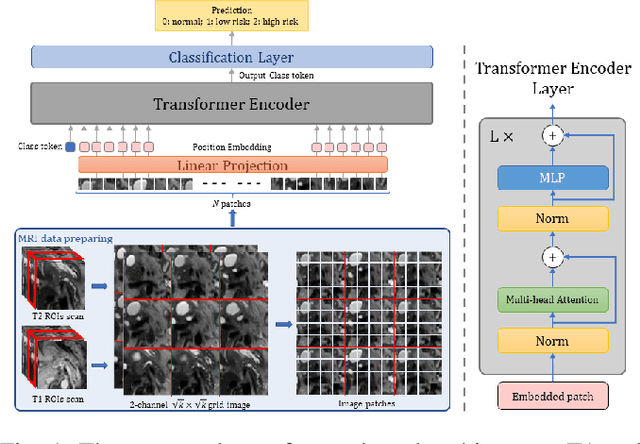 Figure 1 for Neural Transformers for Intraductal Papillary Mucosal Neoplasms (IPMN) Classification in MRI images