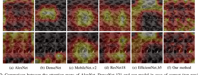 Figure 2 for Neural Transformers for Intraductal Papillary Mucosal Neoplasms (IPMN) Classification in MRI images