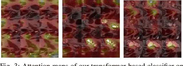 Figure 3 for Neural Transformers for Intraductal Papillary Mucosal Neoplasms (IPMN) Classification in MRI images