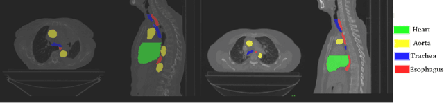 Figure 1 for SegTHOR: Segmentation of Thoracic Organs at Risk in CT images