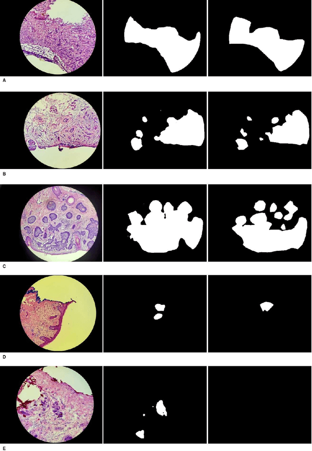 Figure 1 for Deep learning model trained on mobile phone-acquired frozen section images effectively detects basal cell carcinoma