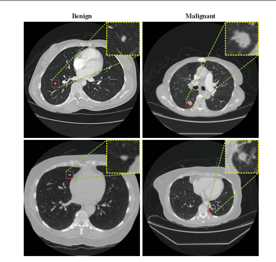 Figure 1 for Interpretative Computer-aided Lung Cancer Diagnosis: from Radiology Analysis to Malignancy Evaluation