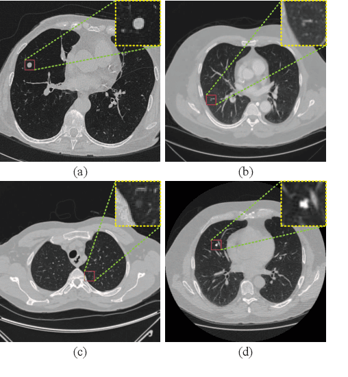 Figure 3 for Interpretative Computer-aided Lung Cancer Diagnosis: from Radiology Analysis to Malignancy Evaluation