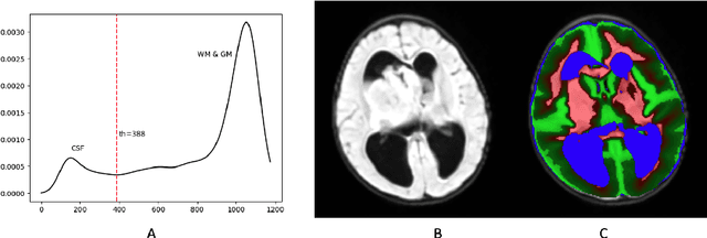 Figure 1 for A Prior Knowledge Based Tumor and Tumoral Subregion Segmentation Tool for Pediatric Brain Tumors