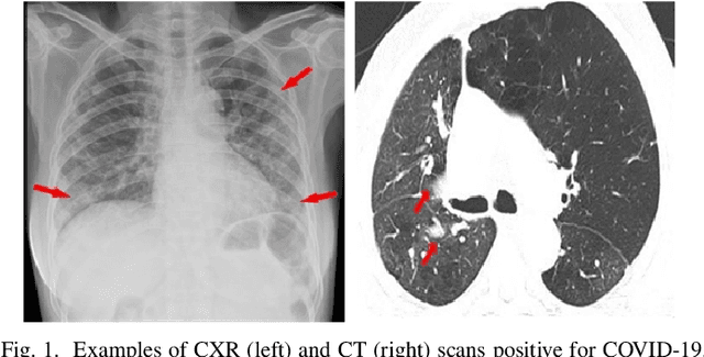 Figure 1 for Multi-scale alignment and Spatial ROI Module for COVID-19 Diagnosis