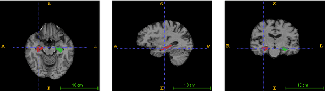Figure 1 for Near Real-time Hippocampus Segmentation Using Patch-based Canonical Neural Network