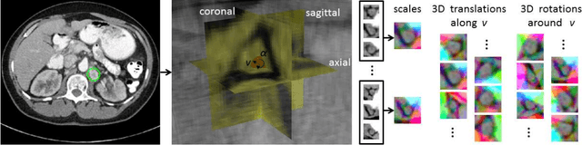 Figure 1 for A New 2.5D Representation for Lymph Node Detection using Random Sets of Deep Convolutional Neural Network Observations