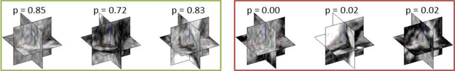 Figure 3 for A New 2.5D Representation for Lymph Node Detection using Random Sets of Deep Convolutional Neural Network Observations