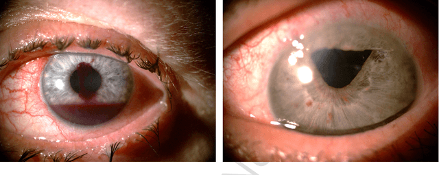 Figure 1 for Implications of Ocular Pathologies for Iris Recognition Reliability