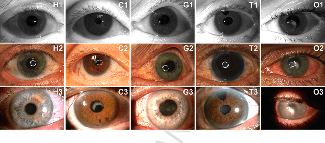Figure 3 for Implications of Ocular Pathologies for Iris Recognition Reliability