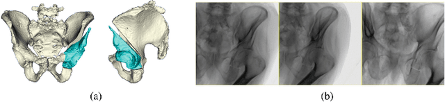 Figure 1 for Patch-Based Image Similarity for Intraoperative 2D/3D Pelvis Registration During Periacetabular Osteotomy
