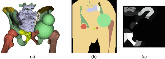 Figure 3 for Patch-Based Image Similarity for Intraoperative 2D/3D Pelvis Registration During Periacetabular Osteotomy